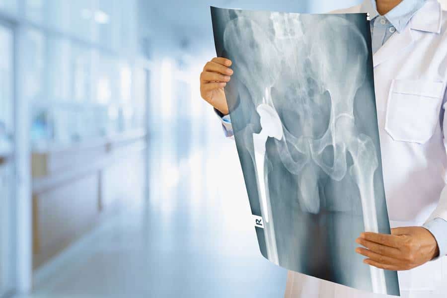 Hip Implant Lawsuit