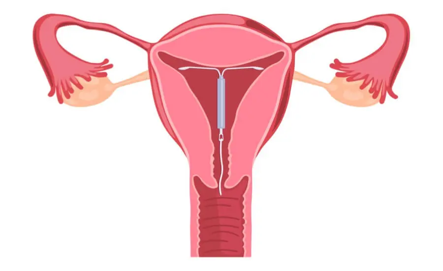 paragard iud lawsuit