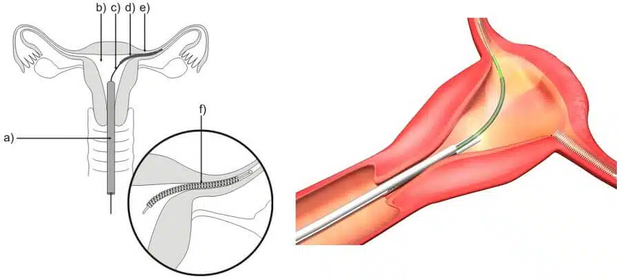 Essure Device