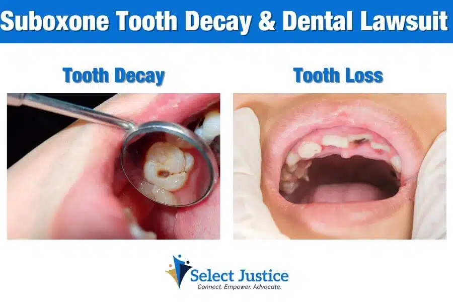 Suboxone Tooth Decay & Dental Lawsuit